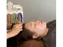 センコウ(SENKOU)/美容鍼