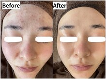 リアリア(LEALEA)/慢性ニキビ