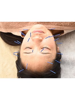 鍼灸施術を受けたい