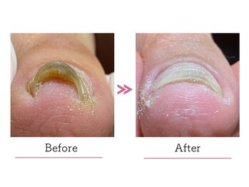 Sisters Nail & 巻き爪Compass/巻き爪