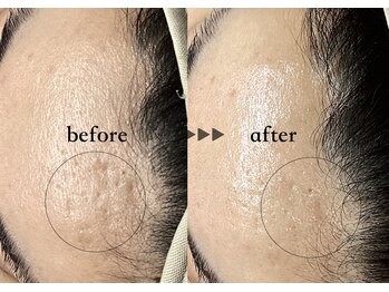 ソーヴ(SOLVE)/ワイコ水光ピーリングでハリ感