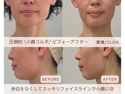 クレン(CLEN)の写真