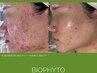 【毛穴集中】毛穴洗浄＋BIOPHYTO＋AI肌診断
