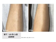 ニコ(Nico)/足脱毛