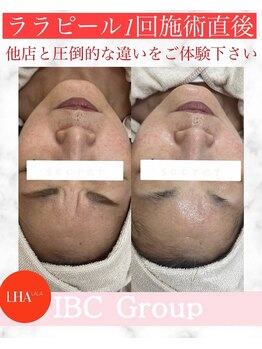 トータルサロンアイビーシー(トータルサロンIBC)/ララピールでつるん肌に!