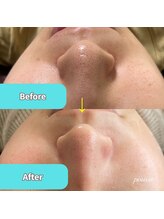 ティンクルホワイト 上尾店/水素水×毛穴洗浄施術後