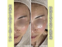 ハニエル(Haniel)/カーボキシー症例