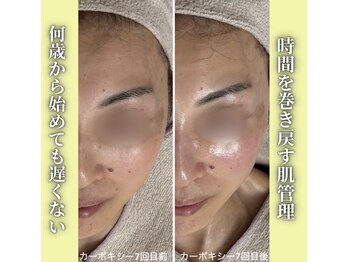 ハニエル(Haniel)/カーボキシー症例