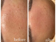 シャルナ(charna)/ニキビケア症例