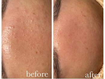 シャルナ(charna)/ニキビケア症例