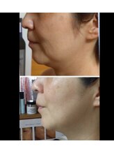 ラグーン(Lagoon)/WINBACK×小顔矯正コルギ