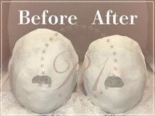 R-1ビューティーサロン 表参道/Before &After（6回）