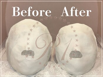 R-1ビューティーサロン 表参道/Before &After(6回)