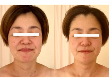 れふぇるん 足利店/40代 たるみにお悩み 施術3回