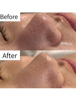 ヒカリエステ 六本木(HIKARI ESTHE)/ハイドラ＋ピーリング＋美容液