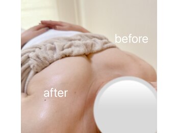 ソルドット(Sol.)/片側のみ施術して比べました♪