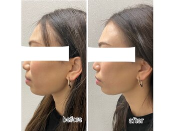 エンチャント(ENCHANT)/ウルトラお顔超音波リフト