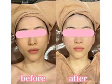 クラッシーガール ダンディエール(QlassyGirl DANDYELL)/【３０代】５回後/透明美白肌