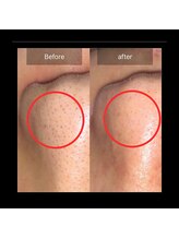 メンズ脱毛 リボーン(reborn)/毛穴すっきりハイドラ