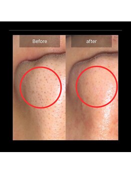 メンズ脱毛 リボーン(reborn)/毛穴すっきりハイドラ