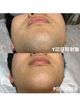 ゆいまーるはうす/メンズヒゲ脱毛9回目