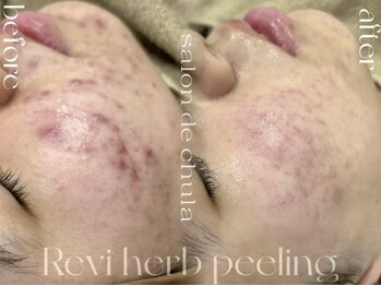 サロンドチュラ(salon de chula)/剥けないハーブピーリング