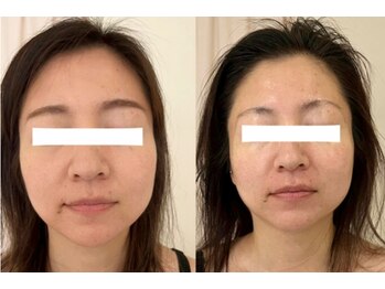 れふぇるん 足利店/30代 毛穴&たるみ改善 施術1回