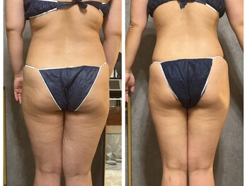 フュース(Futh)/セルライトケア◇途中経過