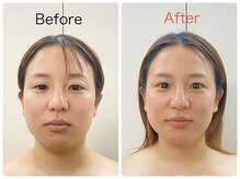 ウニカ(Unica)/施術一回目ビフォーアフター