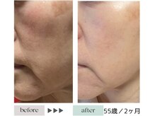 ジェニックサロン グランギンザ ひたちなか(GENIC SALON GRAND GINZA)/最新リフトアップ