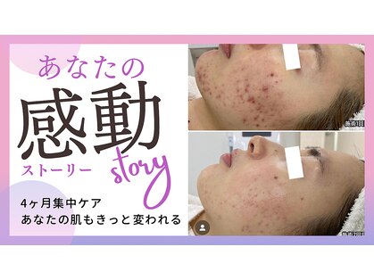 ニキビケア研究所 渋谷店の写真