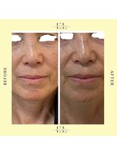 シスタス(Cistus)/ExoLift効果