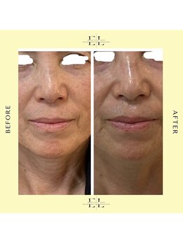 シスタス(Cistus)/ExoLift効果