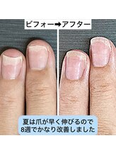 桃の木 吉祥寺店/正しい保湿ケアで早く改善します