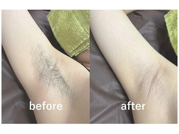 ヴィ オール(Vi.all)の写真/【19時まで！スマート支払い限定】最新ハイブリッド脱毛VIO+顔込全身74箇所1回通常¥16750⇒¥8500◎