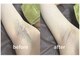 ヴィ オール(Vi.all)の写真/【19時まで！スマート支払い限定】最新ハイブリッド脱毛VIO+顔込全身74箇所1回通常¥16750⇒¥8500◎