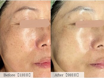 オーキッド(ORCHID)/シミシワケア!