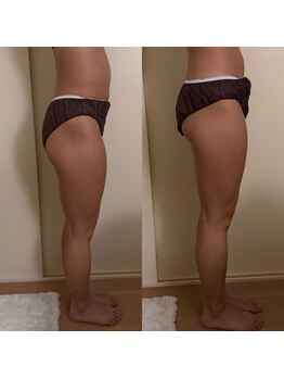 シーアイエステティック 船橋駅前店(c.iエステティック)/大腿部&腹部のレモンボトル♪