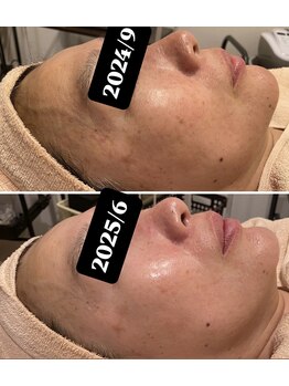 トータルエステティック ジョワイユ(JOYEUX)/乾燥、毛穴、シミ、くすみ改善