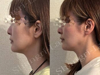 シャングリラ(Shangri-La)/小顔矯正×レモンボトル