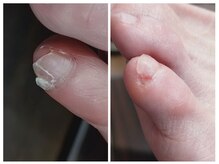 アンティ(Aunty)/副爪