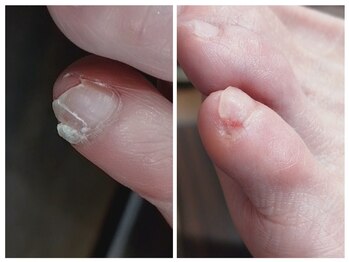 アンティ(Aunty)/副爪