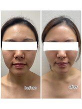 エンチャント(ENCHANT)/小顔造形×ラジオ波.EMS.EL