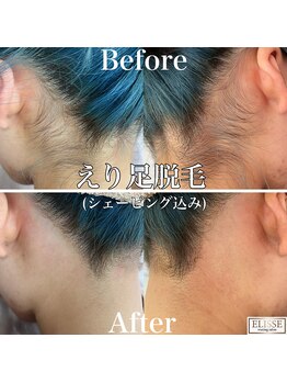エリス(ELISSE)/えり足脱毛