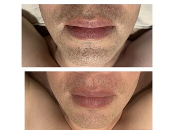 スマイルミー/メンズ脱毛