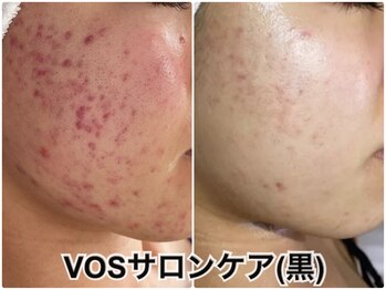 ルアナライフ(Luana Life)/肌荒れ改善VOSサロンケア黒 20代