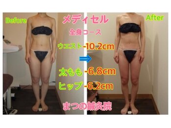 まつの鍼灸院/メディセルで全身セル脂肪撃退
