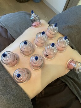 エヌホープ(N hope)/スライドカッピング（吸い玉）