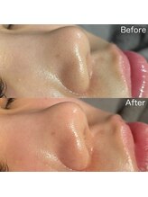 ア レーズ(a laise)/ハイドラフェイシャル☆