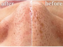 ラティエル(Latiele)/結果重視の毛穴ケア！